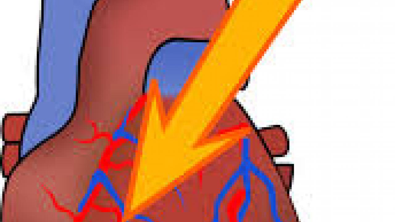 Clipart representing cardiac dysrhythmias