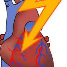 Clipart representing cardiac dysrhythmias